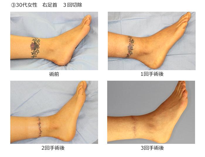 irezumi6