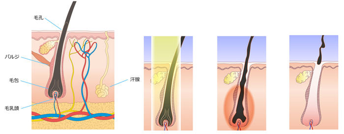 ひげ 男性の脱毛 スキンクリニック藤枝 静岡の脱毛 医療レーザー脱毛 しみ治療の美容皮膚科 形成外科