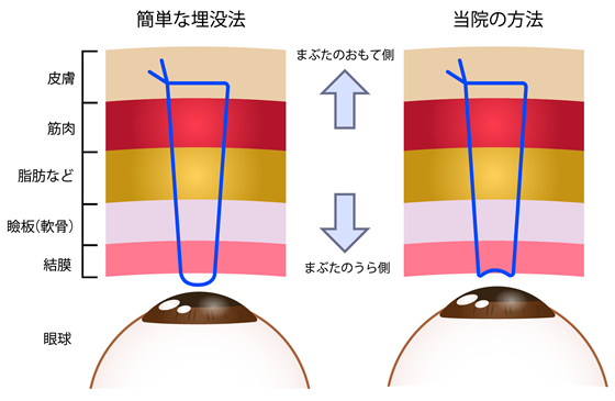 二重・プチ整形