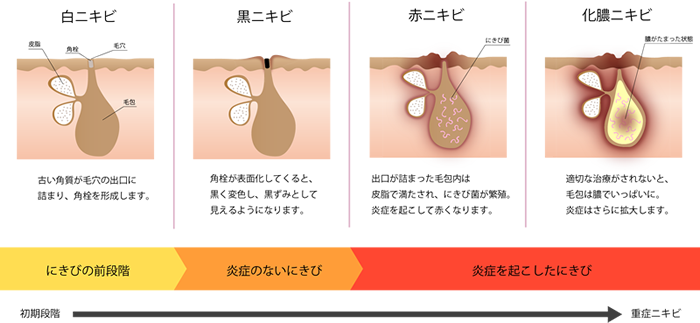 ニキビ ニキビ跡 スキンクリニック藤枝 静岡の脱毛 医療レーザー脱毛 しみ治療の美容皮膚科 形成外科