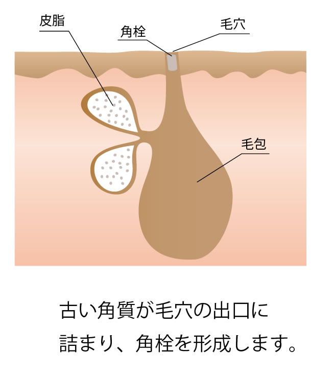 ニキビ ニキビ跡 スキンクリニック藤枝 静岡の脱毛 医療レーザー脱毛 しみ治療の美容皮膚科 形成外科