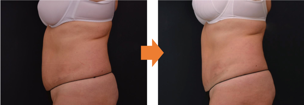 症例写真、腹部前面