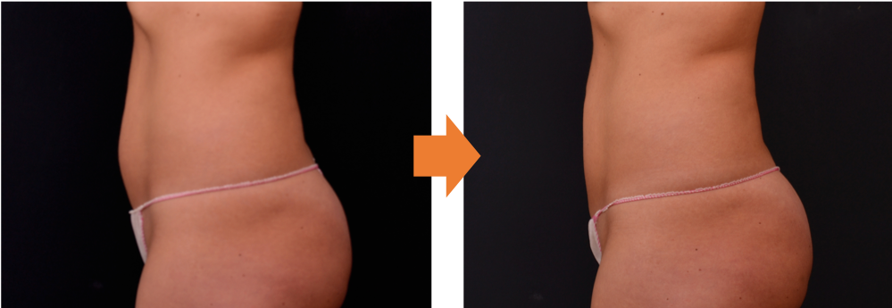 症例写真、腹部前面