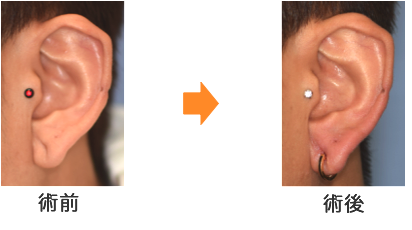耳垂裂(拡張し過ぎたホールによる)の修正
