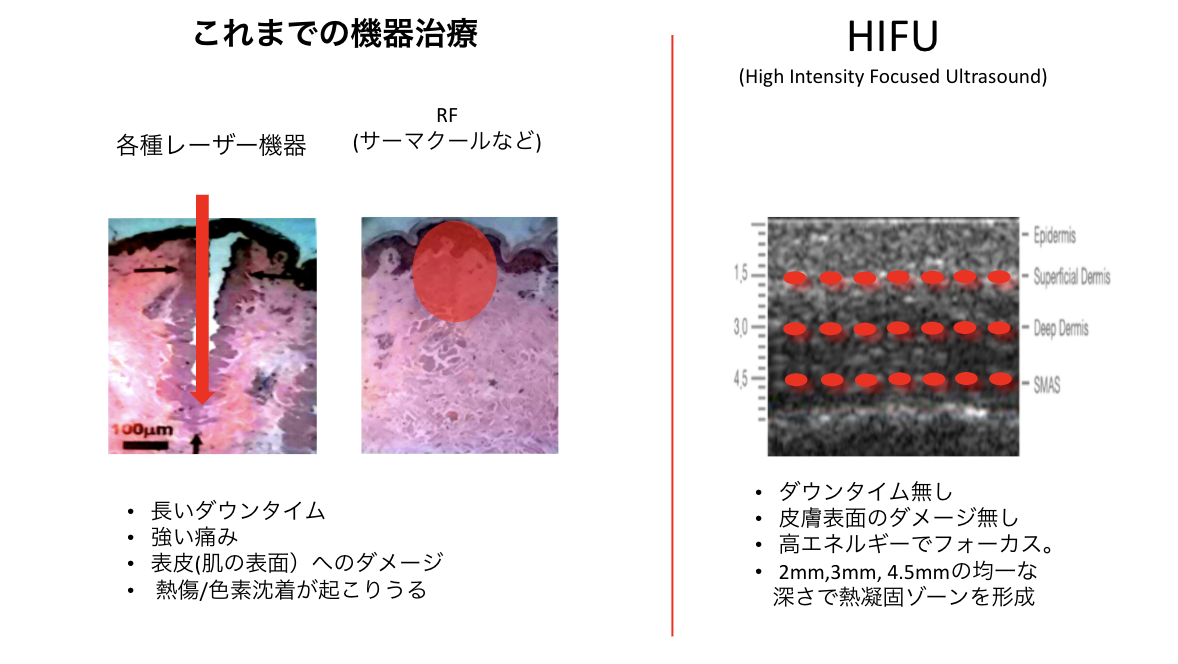 hifu3