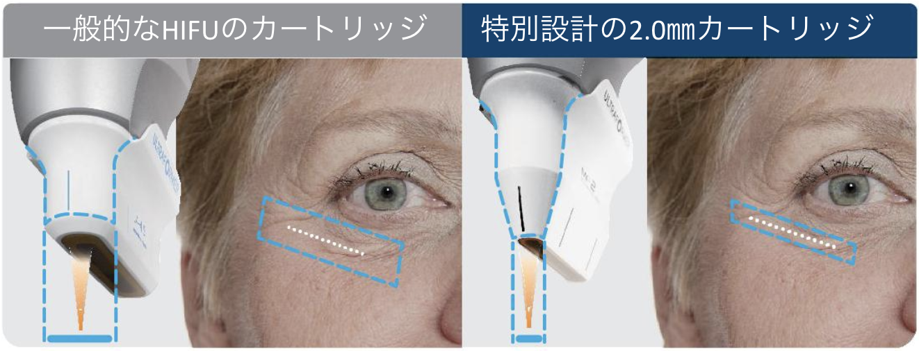 hifu7