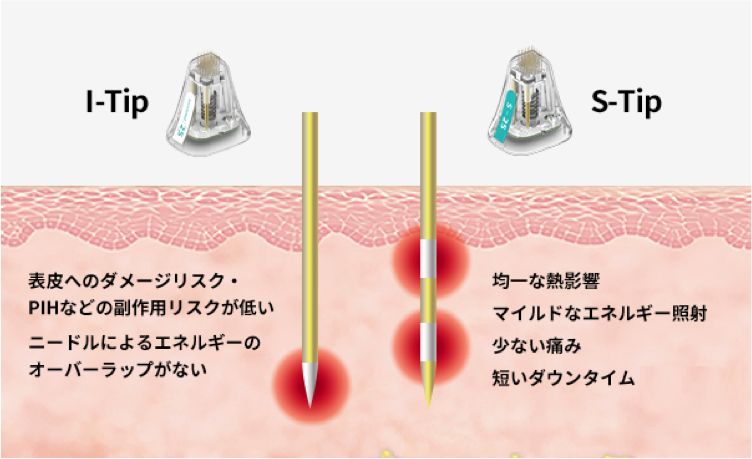 ポテンツァのI-tipとS-Tipの違い