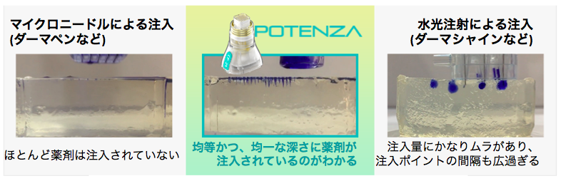 ポテンツアとマイクロニードルによる注入と水光注射の違い
