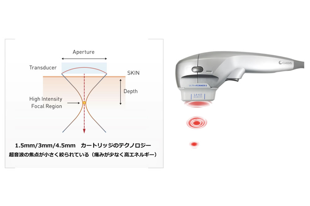 ハイフHIFU 超音波美顔器 HIFU Ultrasound（医療HIFU（ハイフ）の料金 
