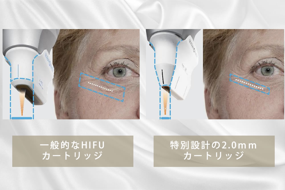 医療HIFU（ハイフ）の料金や施術内容｜静岡の美容皮膚科・美容外科なら 