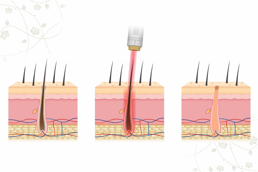 レーザー脱毛の原理