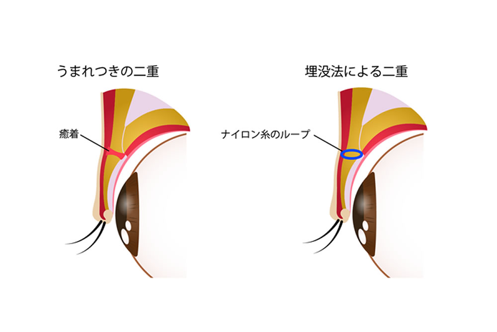 埋没法の仕組みの図解