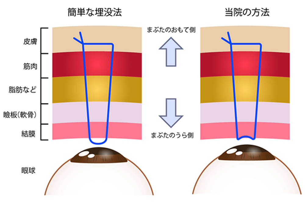 埋没法の目の断面図を使用した図解