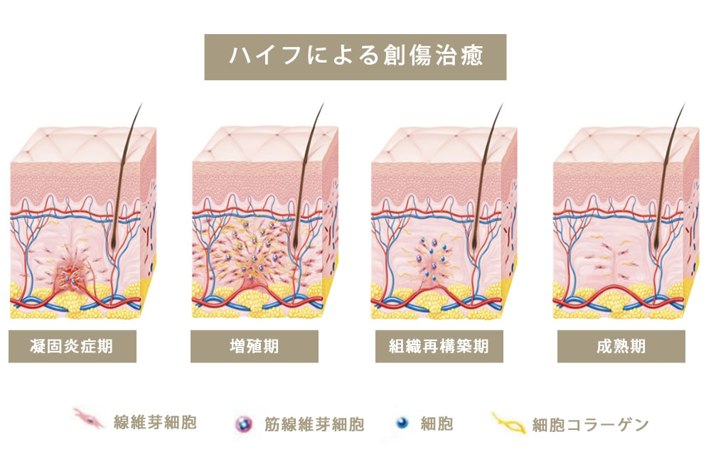 ハイフによる創傷治癒の図解