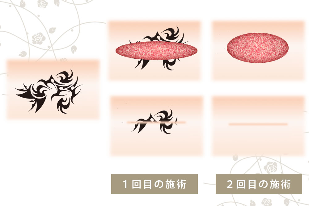 連続切除法の図解