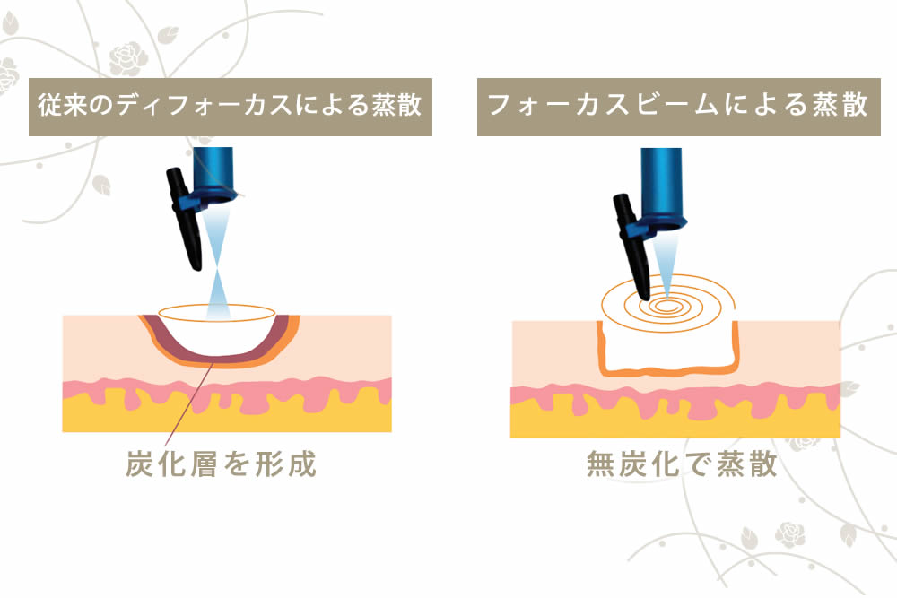 アキュパルスのレーザーの図解