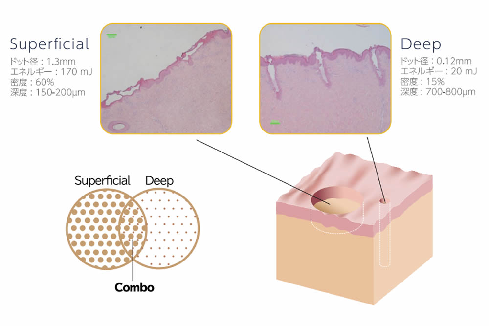 フラクショナルレーザーの図解