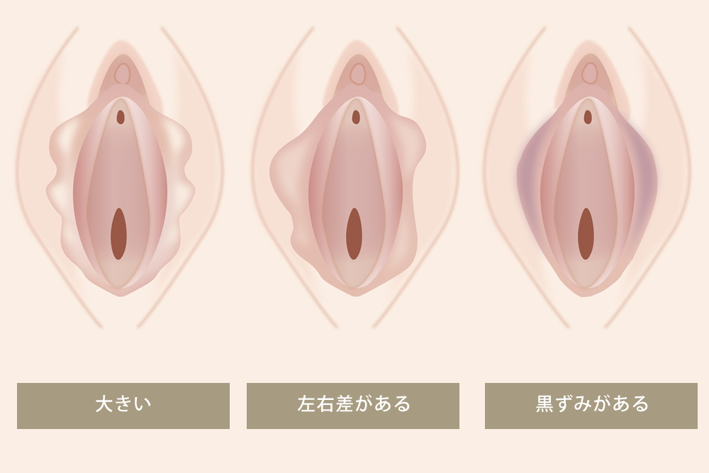 小陰唇の悩みの図解
