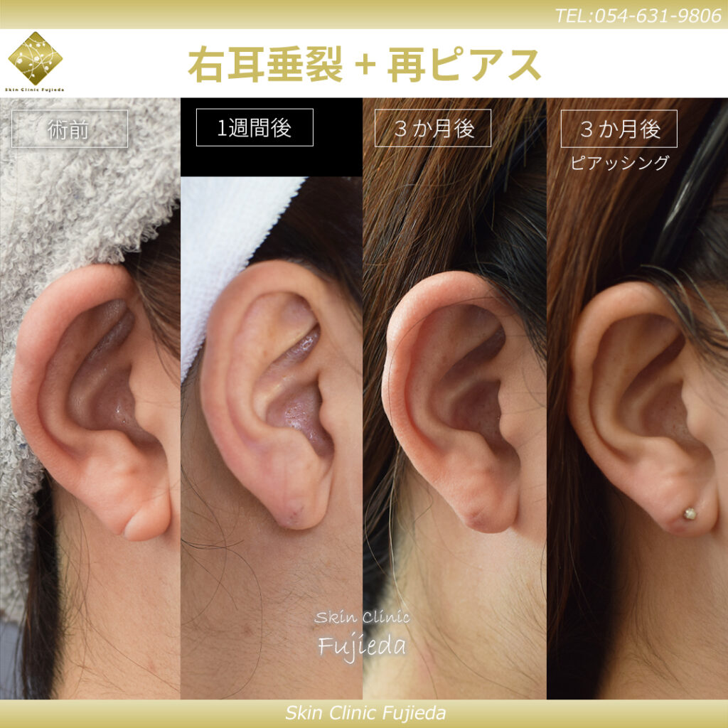 医療ピアスを開ける場合の料金や施術内容｜静岡の美容皮膚科・美容外科 