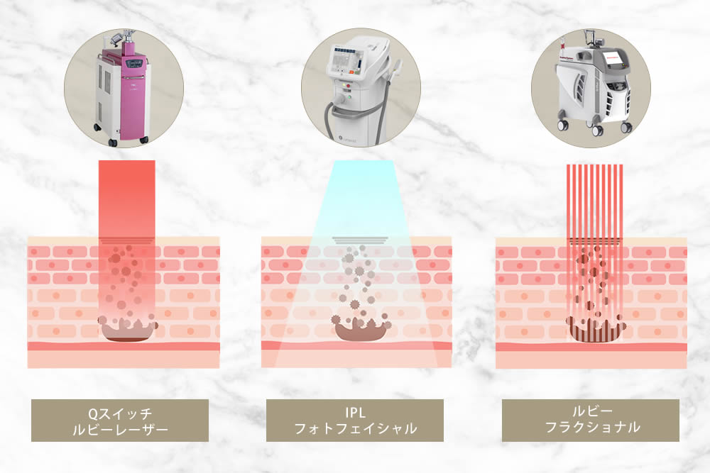 ルビーレーザーとルビーフラクショナル レーザとフォトフェイシャルの比較の図解