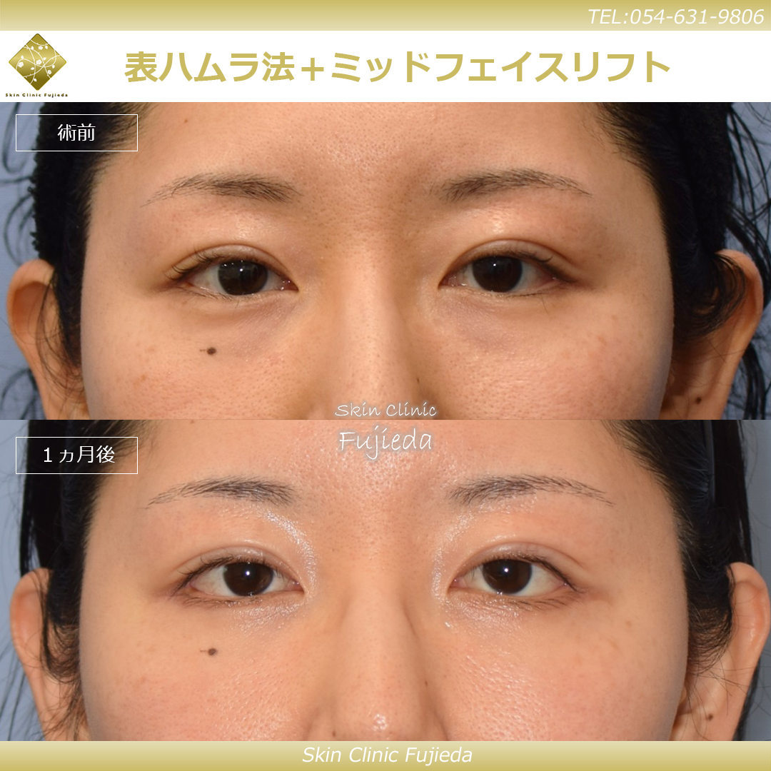 症例写真 | 静岡の美容皮膚科・美容外科ならスキンクリニック藤枝院