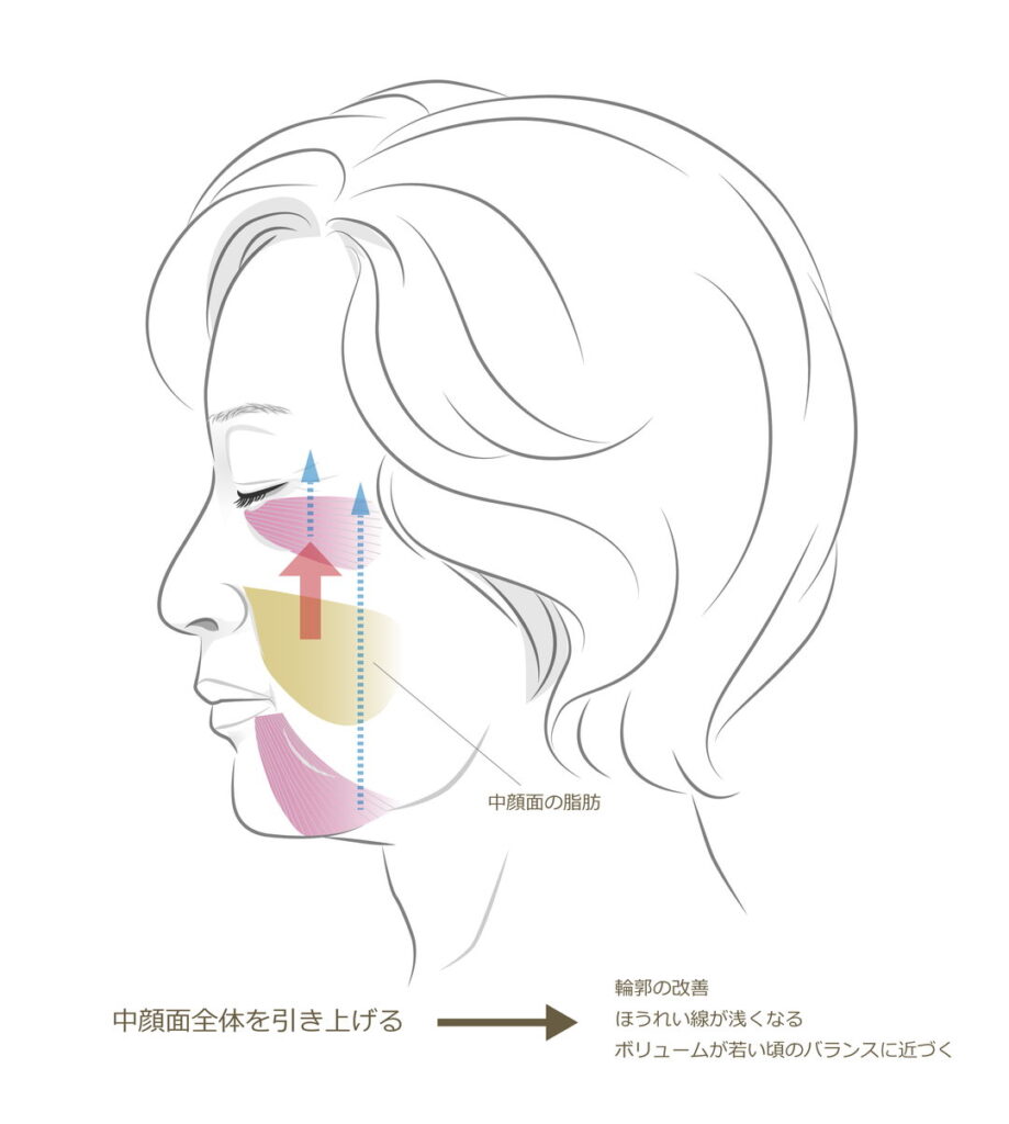ミッドチークリフトの図解