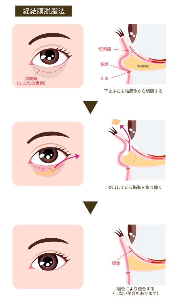 経結膜脱脂の図解