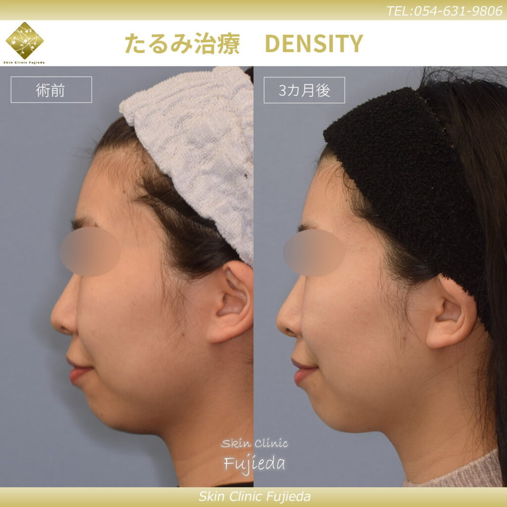 DENSITYの１か月後の症例 (3)
