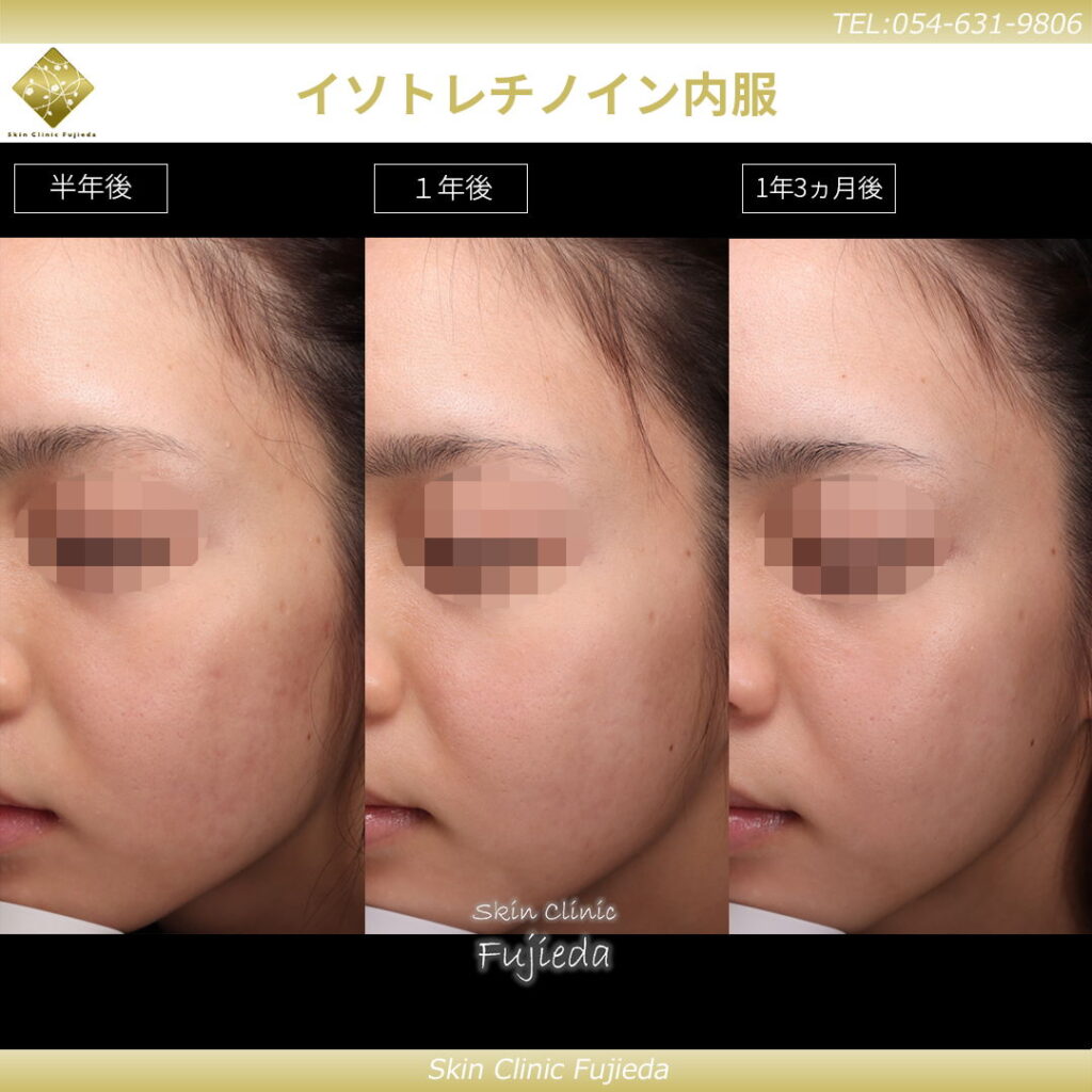 イソトレチノインの半年から１年３ヶ月後までの症例写真