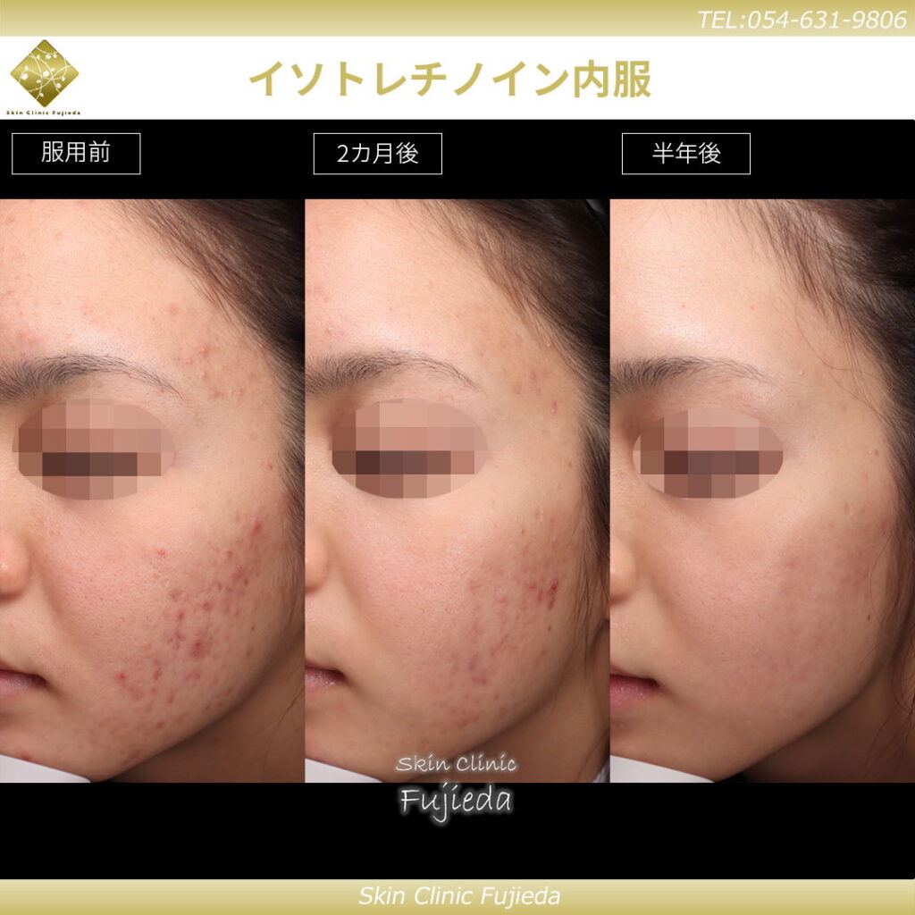 イソトレチノインの半年後までの症例写真
