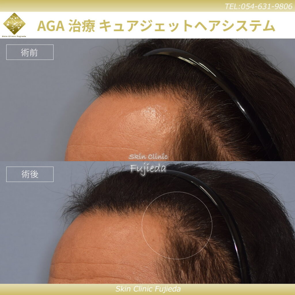 キュアジェットのAGA治療