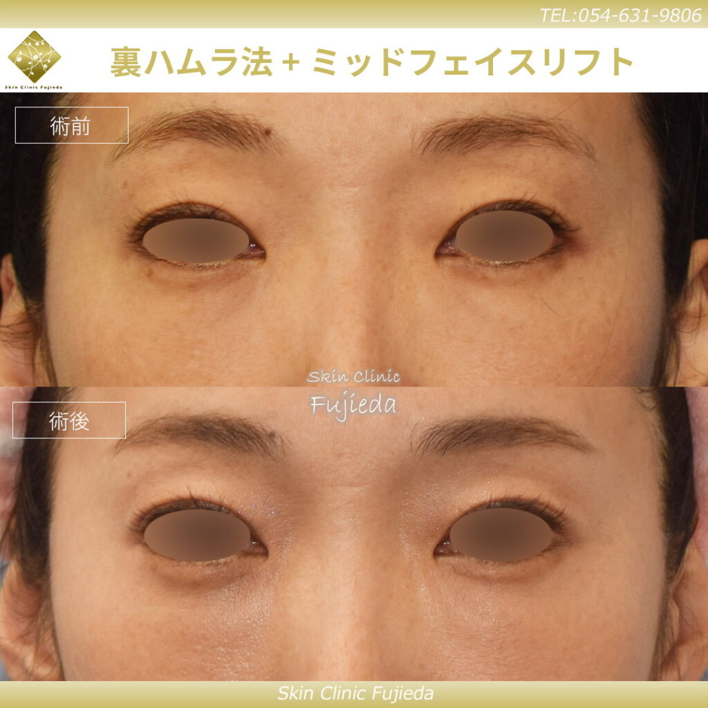裏ハムラとミッドフェイスリフトの症例