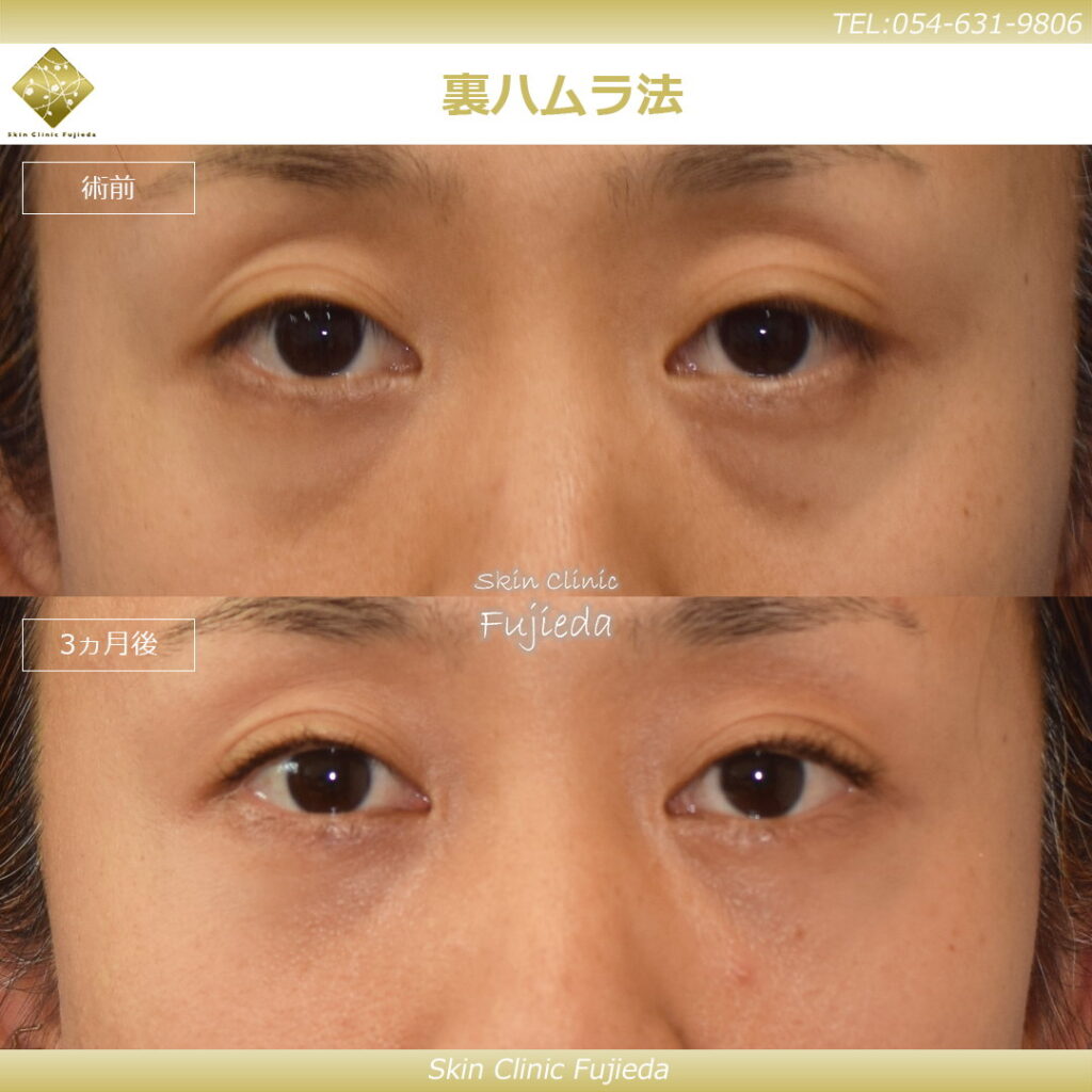 裏ハムラの症例写真